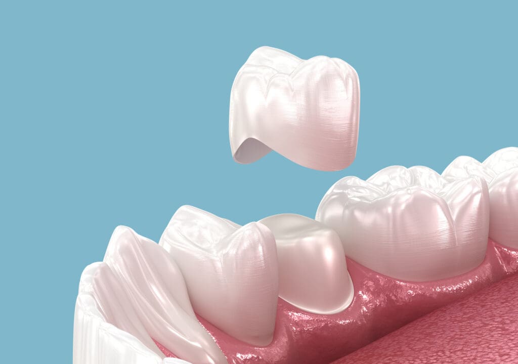 dental crowns at canatella dental in new orleans